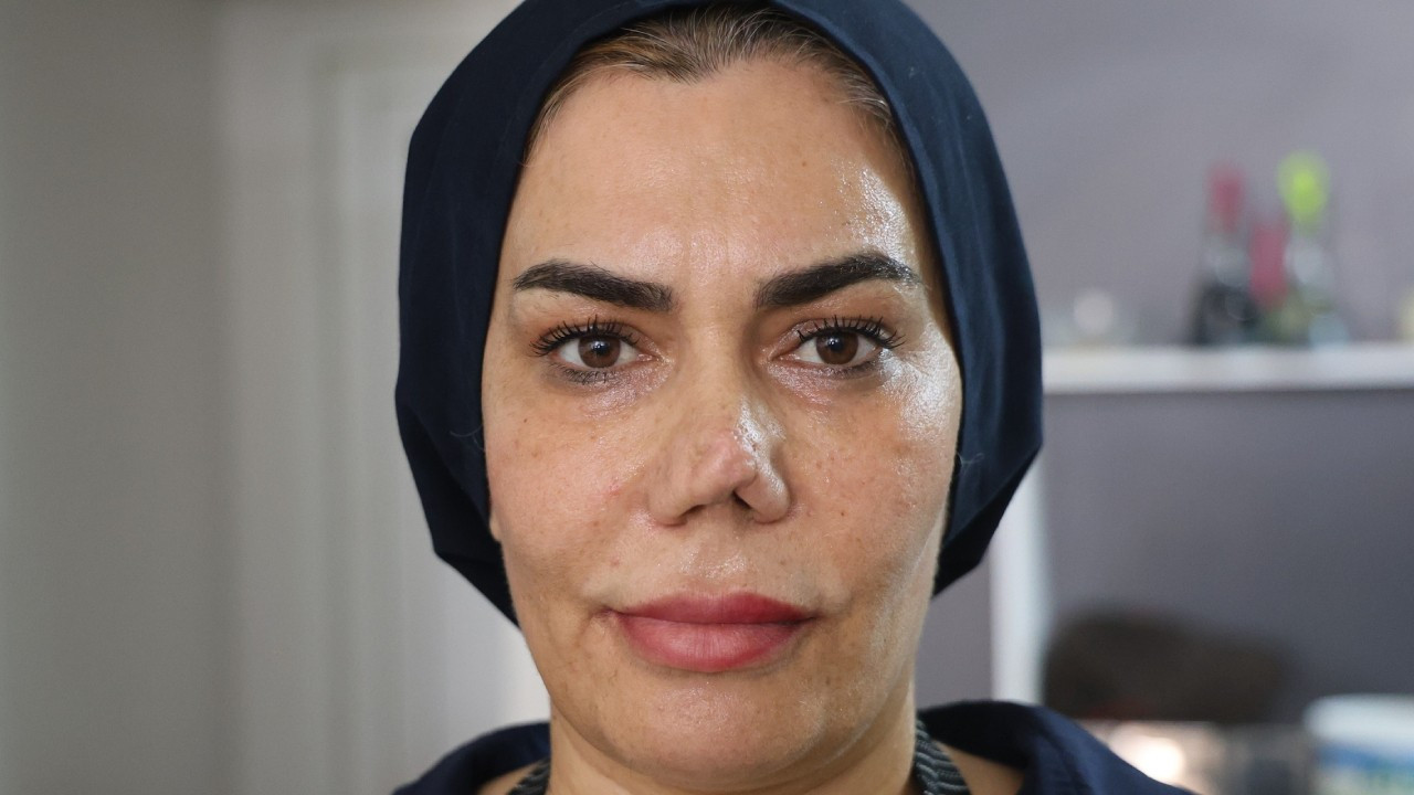 Her ameliyat öncesi tam altın verdi, son halini görünce aynalara küstü