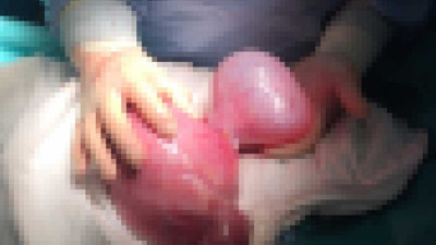 Diyetle geçirmeye çalıştı, 5 kiloluk kist çıktı