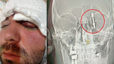 İmplant beynine saplandı, 2 yıldır adalet bekliyor