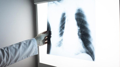 DS&Ouml; a&ccedil;ıkladı: 2024 yılında 1,2 milyon kişi t&uuml;berk&uuml;lozdan &ouml;ld&uuml;