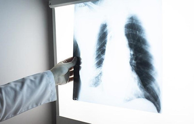 DSÖ açıkladı: 2024 yılında 1,2 milyon kişi tüberkülozdan öldü