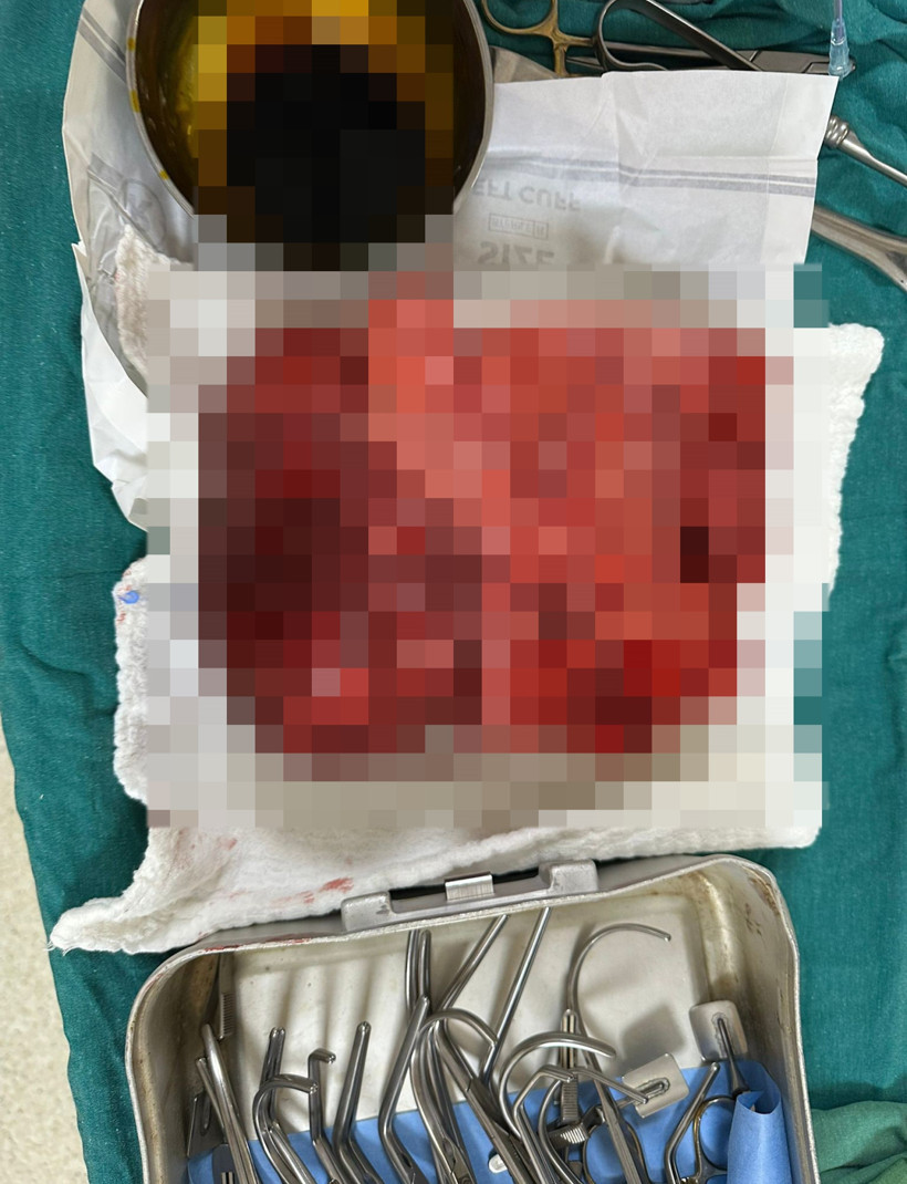 Nefes darlığı şikâyetiyle hastaneye başvurdu, tüm bunlar göğsünden çıktı! - Resim : 2