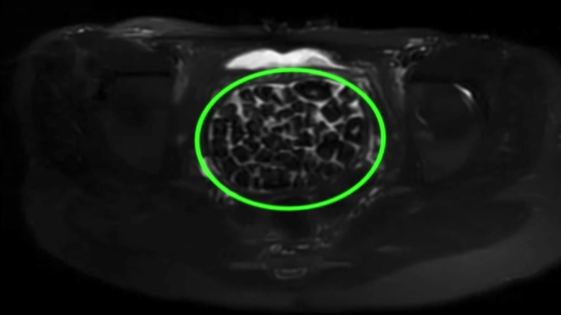 Doktorlar 'nadir rastlanan vaka' diyerek açıkladı! 21 yaşındaki  kızın vücudundan 287 taş çıkarıldı - Resim : 1