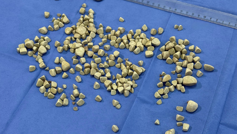 Doktorlar 'nadir rastlanan vaka' diyerek açıkladı! 21 yaşındaki  kızın vücudundan 287 taş çıkarıldı - Resim : 2