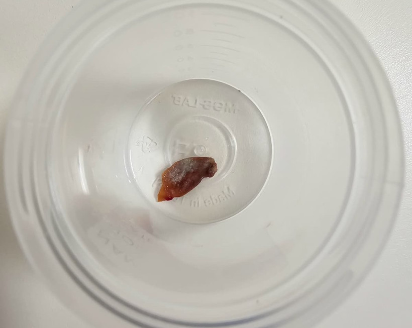 Kanserden astıma pek çok teşhis koydular: Akciğerinden çıkan şey doktorları şaşkına çevirdi - Resim : 1